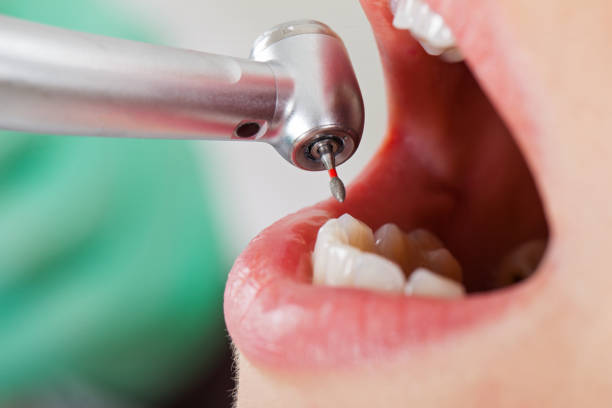 Best Emergency Wisdom Tooth Extraction in The Hammocks, FL